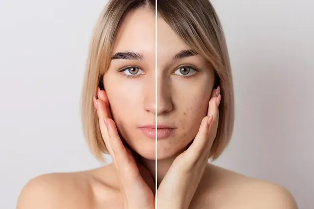 Acne Repair Treatment